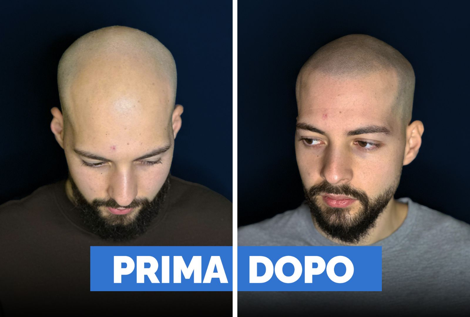 Prima e dopo tricopigmentazione 1