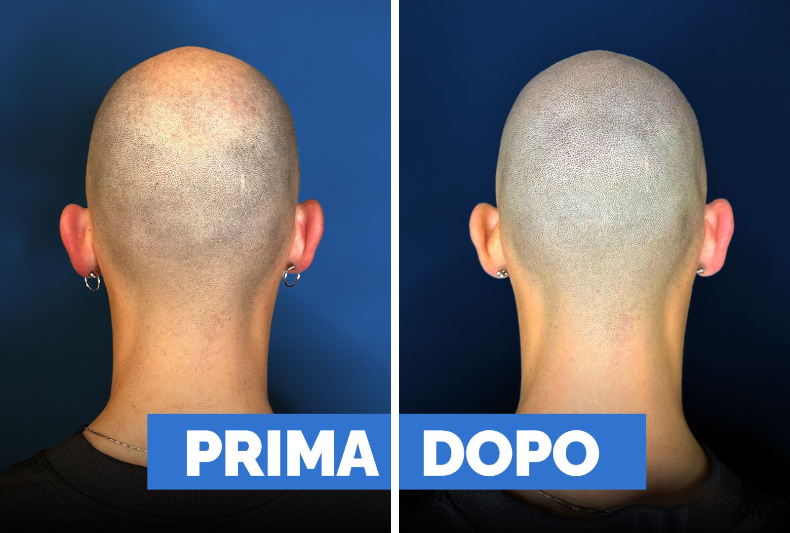 Prima e dopo tricopigmentazione 2
